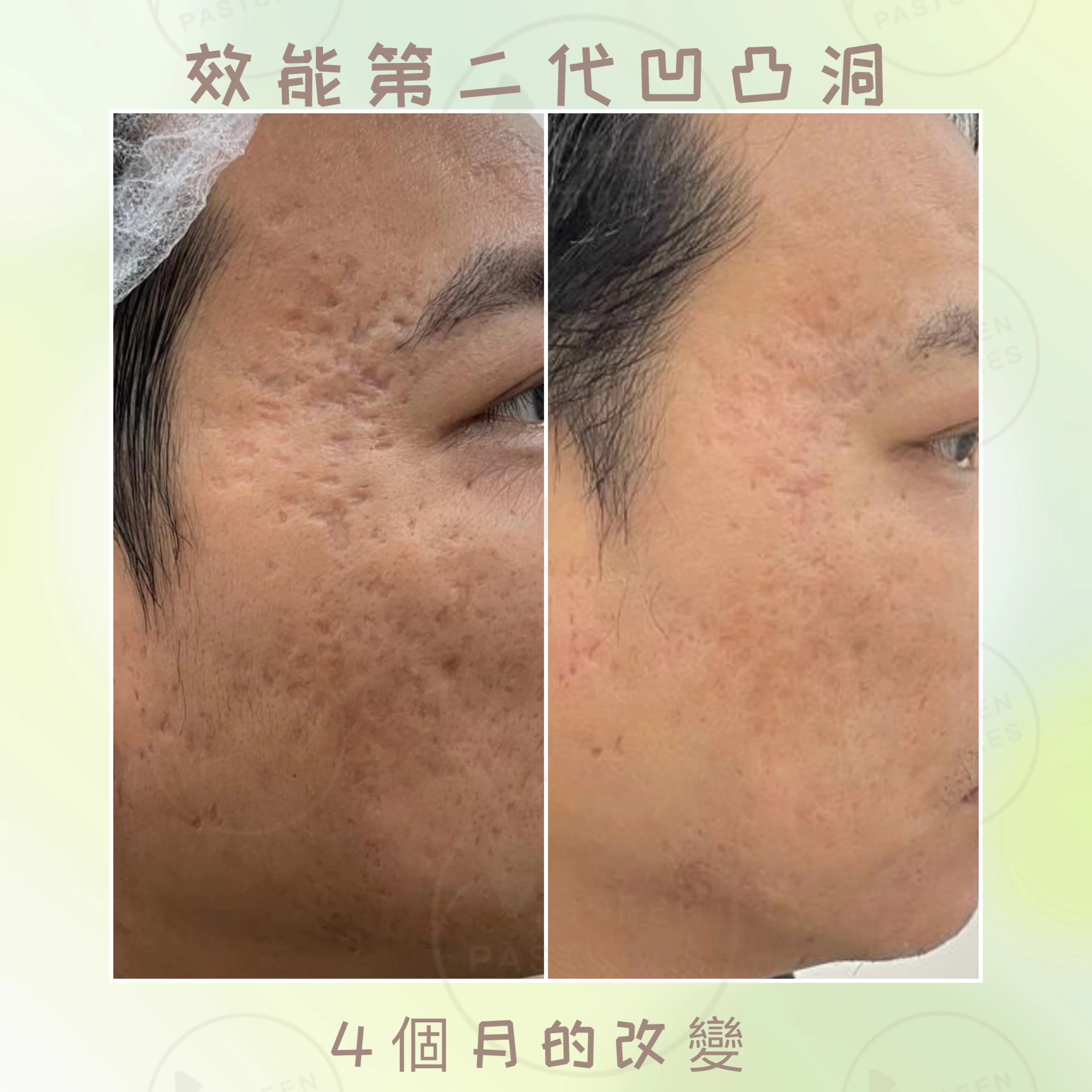效能第二代ViVace: 終極凹凸洞、暗瘡治療組合(只限銅鑼灣店